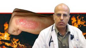 ד"ר עאמר חוסיין, מנהל מחלקת המיון במרכז הרפואי זיו, בצפת, כללי זהירות והטיפול בכוויות ליד המדורה | עיבוד: שולי סונגו
