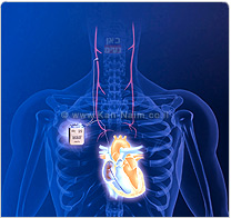 סטימולטור עצבי לטיפול באי-ספיקת לב CardioFit מחידושי שבוע ILSI - ביומד ישראל 2007