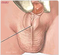 ניתוח נדיר לשחזור צינור השופכה בפעוט בן שנתיים במרכז רפואי זיו