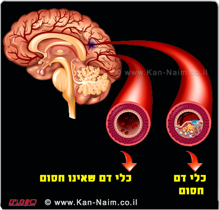 חולה שבץ מוח ראשון, טופל ב-טייגרטריבר (Tigertriever) של חב’ רפיד מדיקל