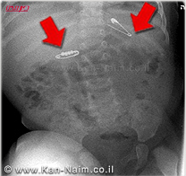 מרכז רפואי כרמל: בת חצי שנה, בלעה 2 סיכות ביטחון, ניצלה ע