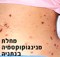 רשויות הבריאות הורו לחסן עשרות ילדים מנתניה, שבאו במגע עם ילד שככל הנראה חלה במנינגוקוקסמיה
